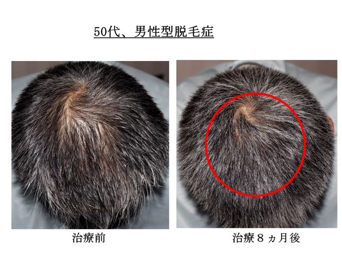 円形脱毛症　病院